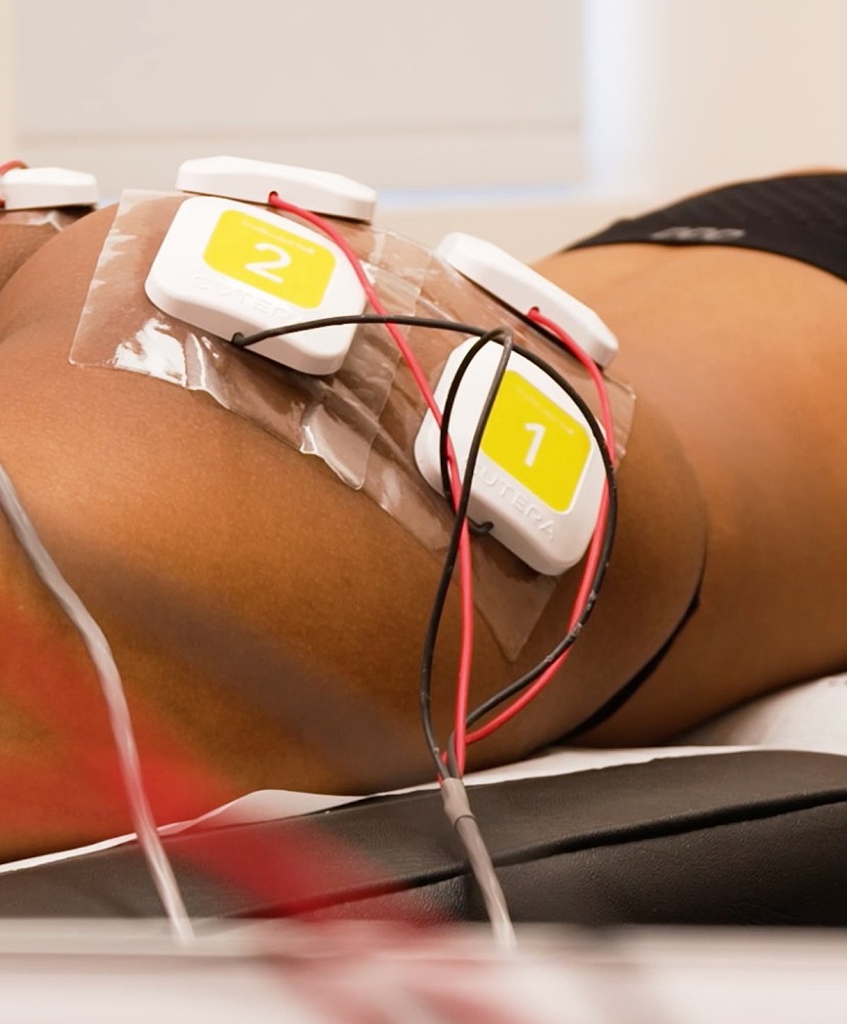 Electrical stimulation therapy on a patient's back.