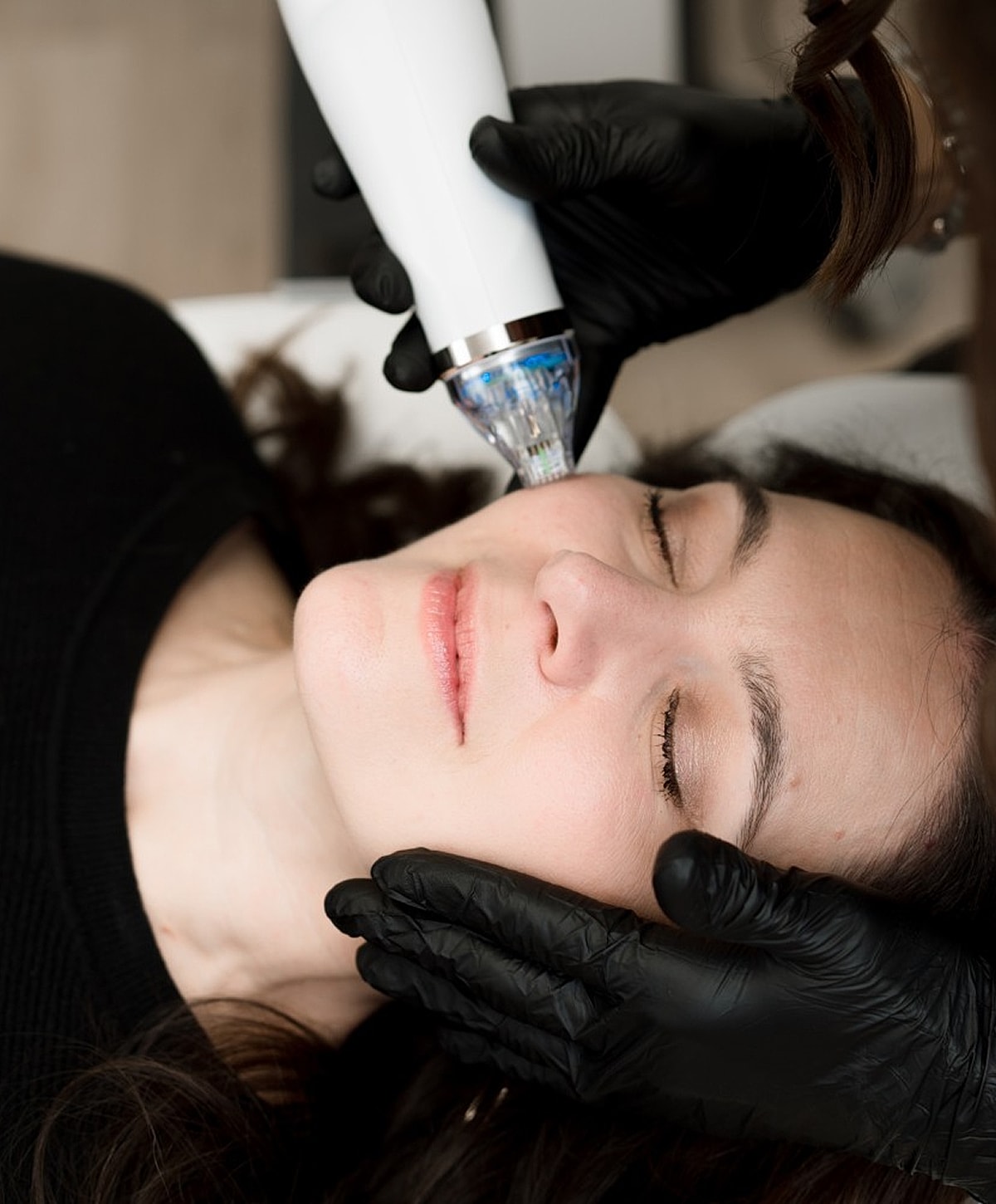 Skin treatment procedure with a microdermabrasion device.