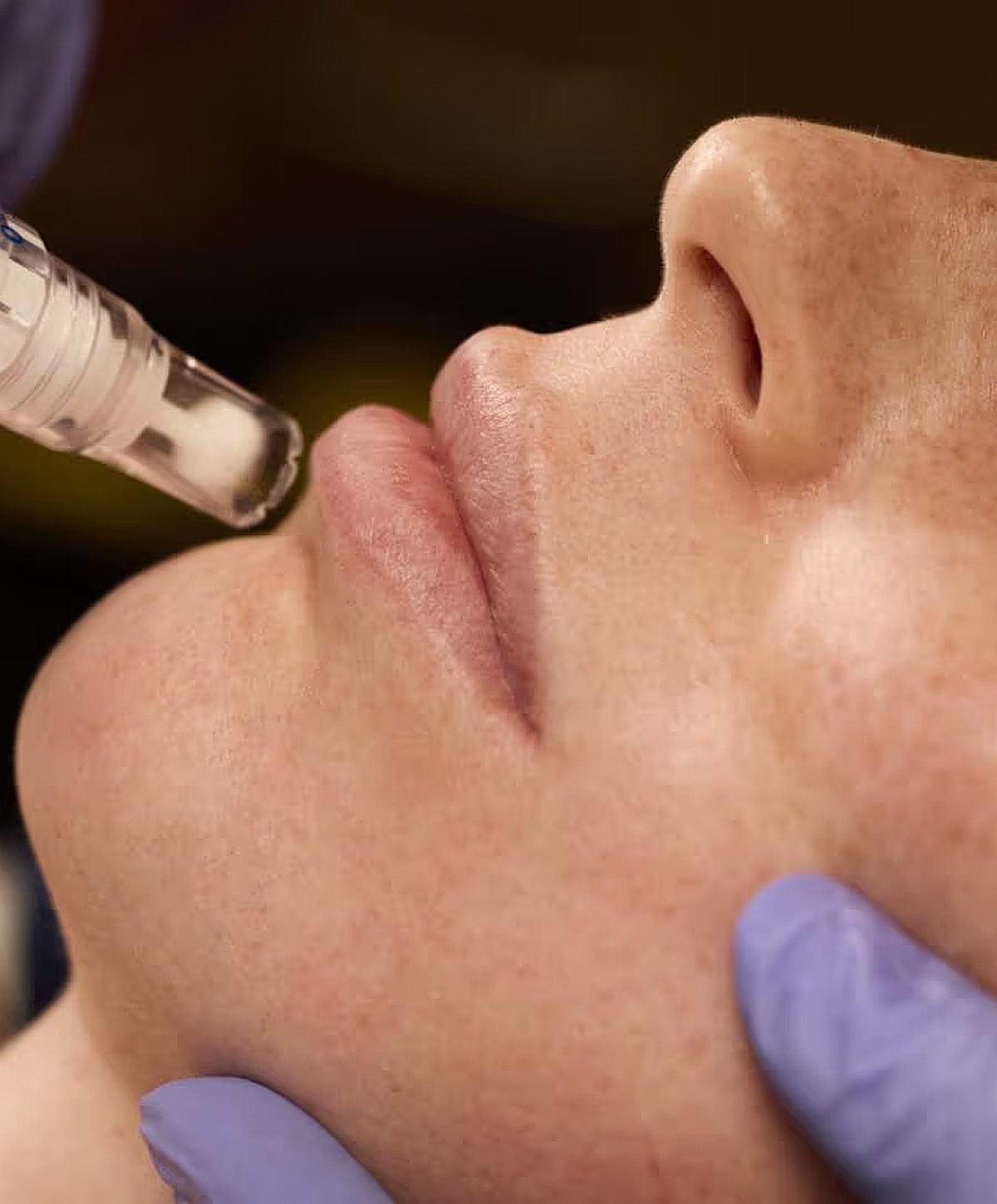 Microneedling treatment on a woman's lips.