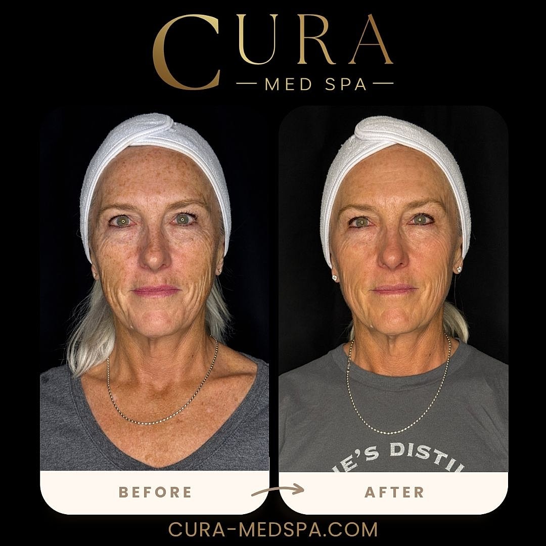 IPL Laser Gallery Before & After