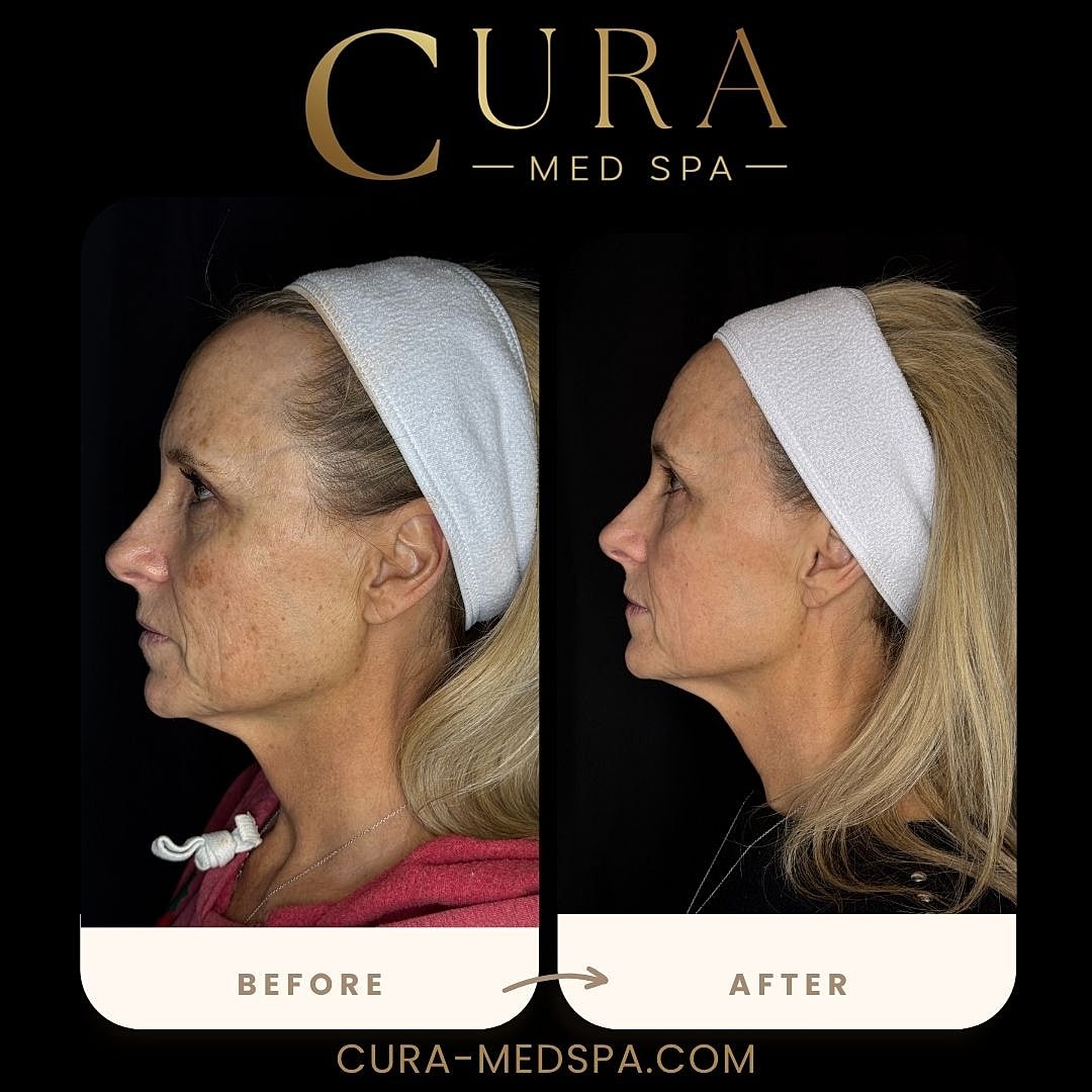 IPL Laser Gallery Before & After
