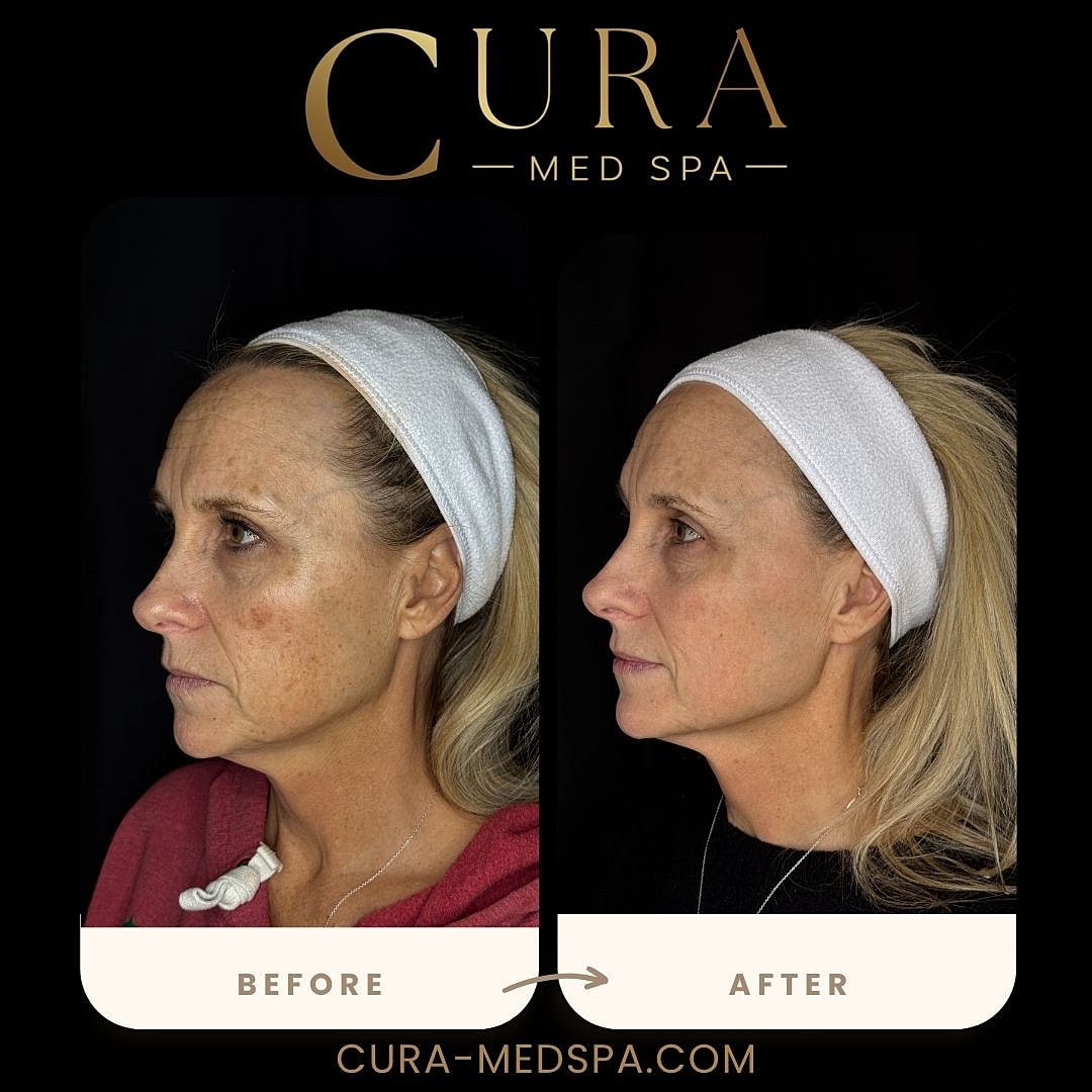 IPL Laser Gallery Before & After