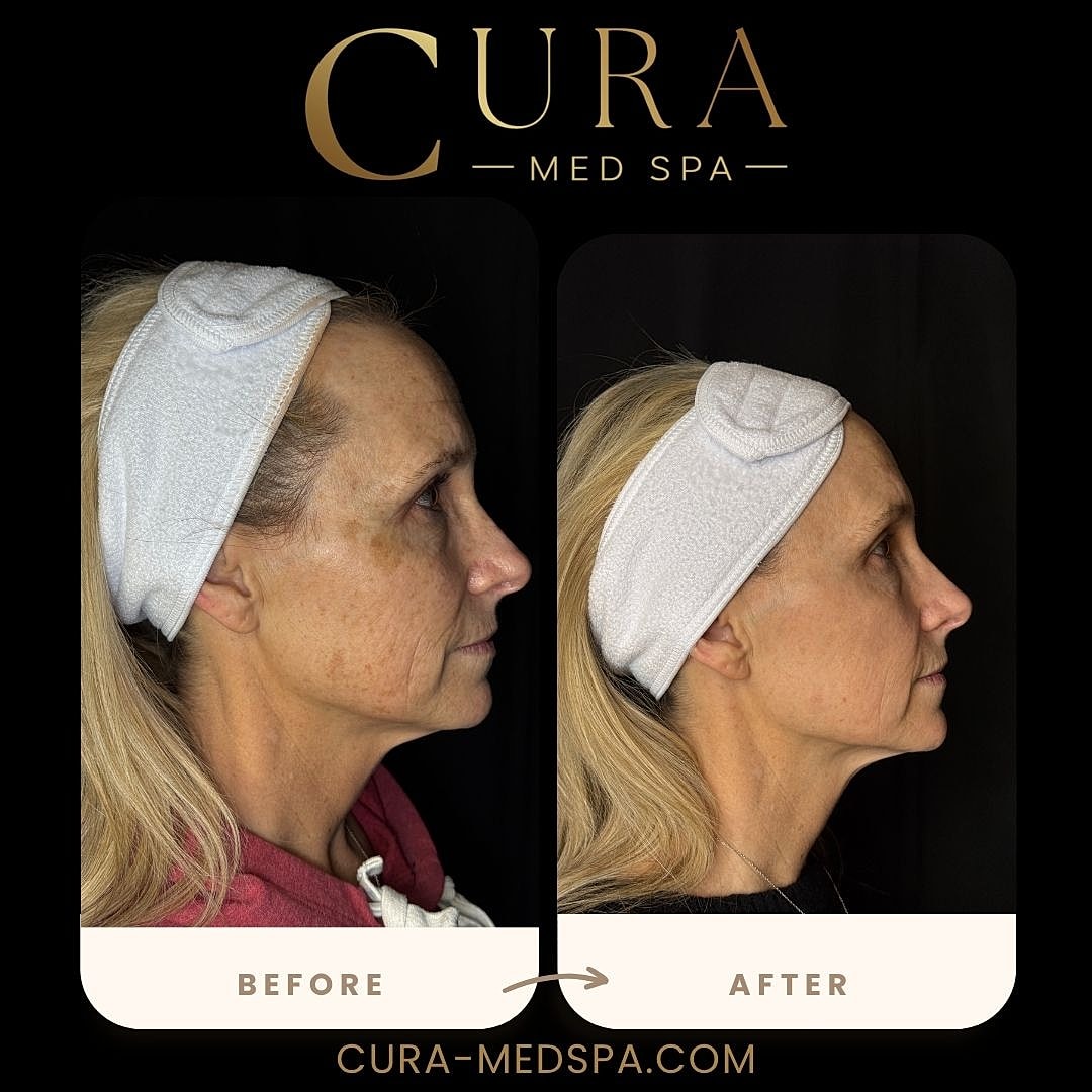 IPL Laser Gallery Before & After