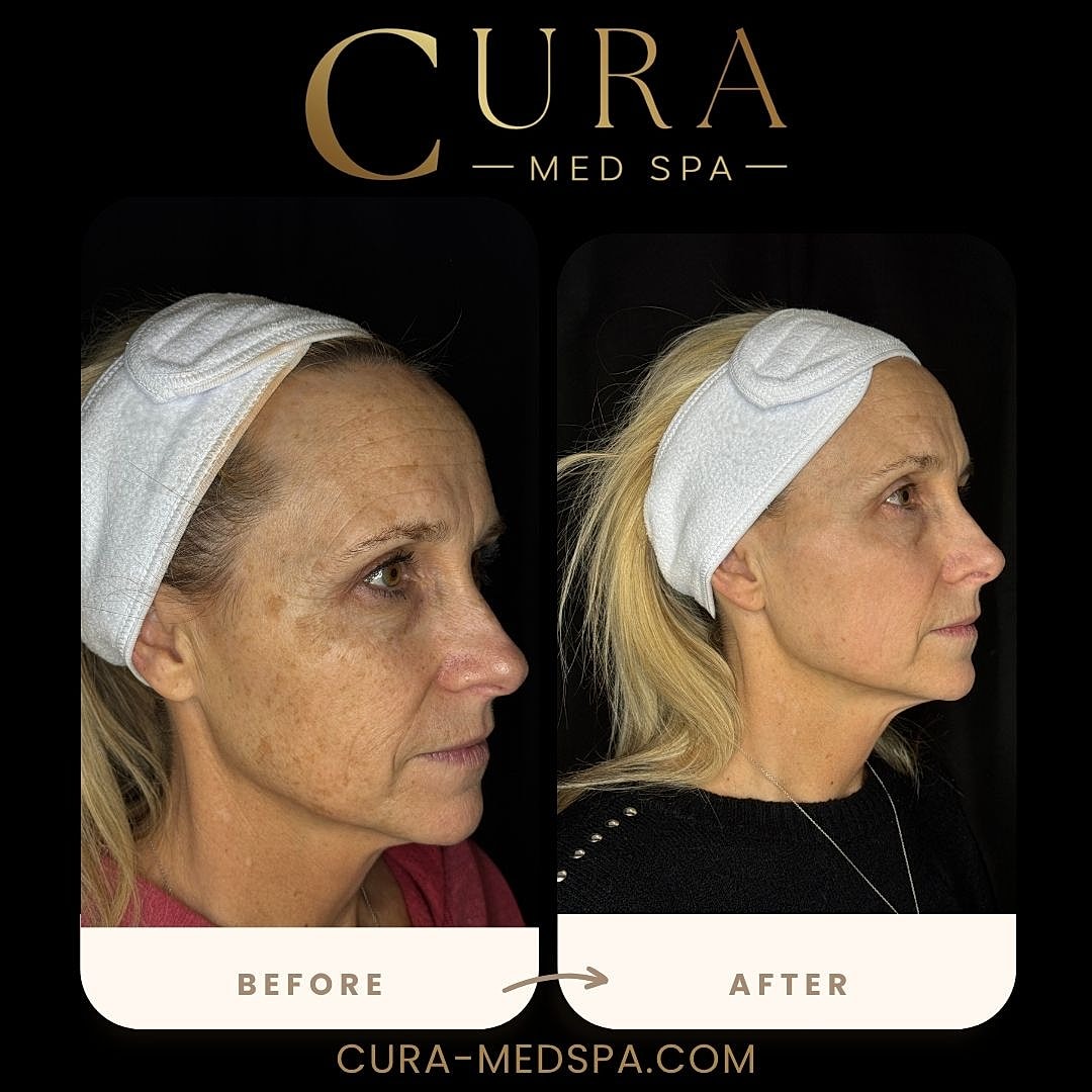 IPL Laser Gallery Before & After