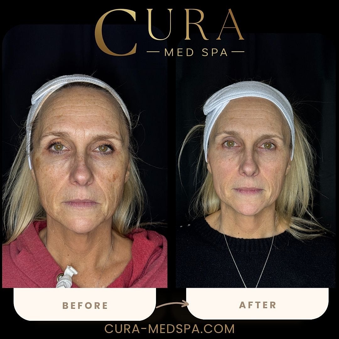 IPL Laser Gallery Before & After