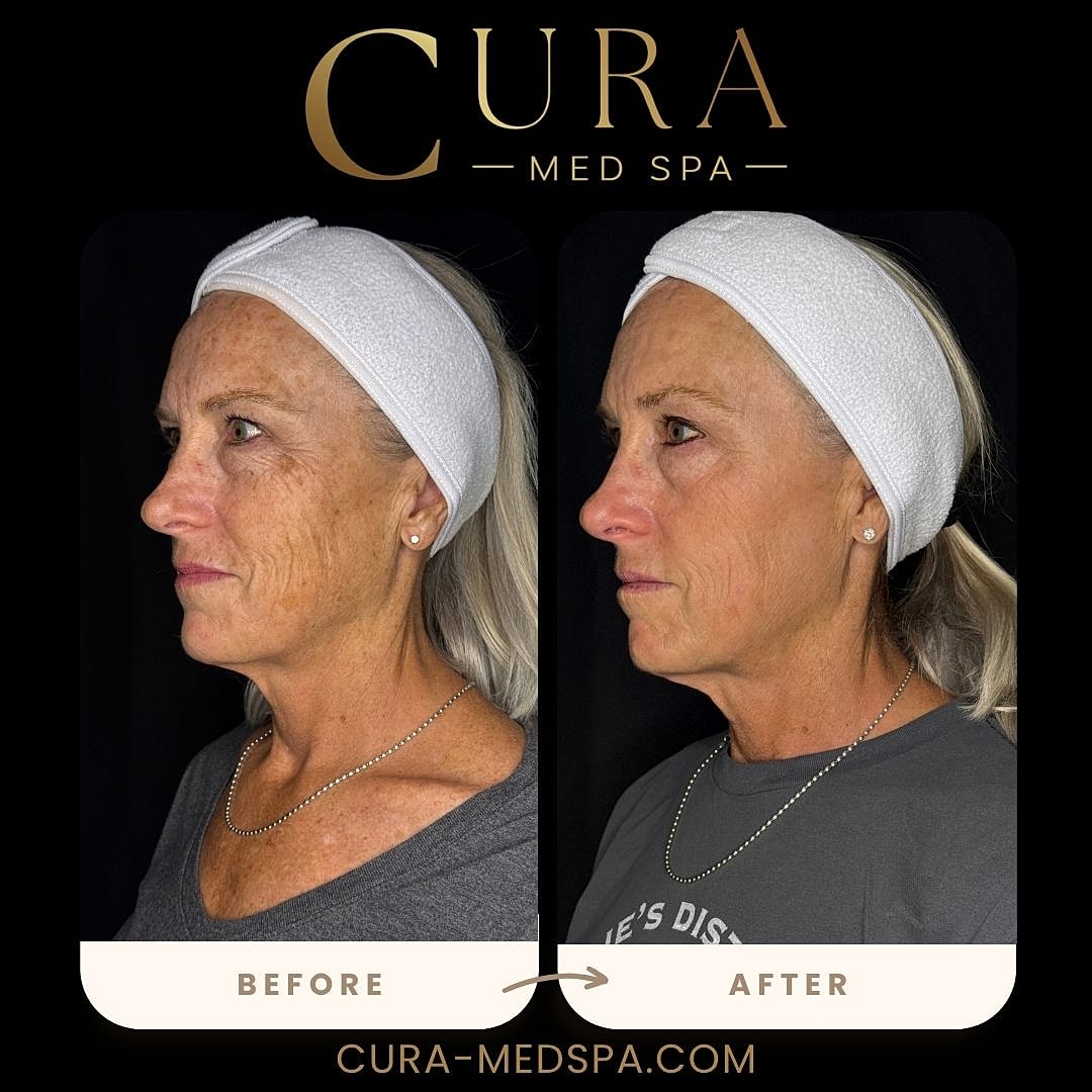 IPL Laser Gallery Before & After