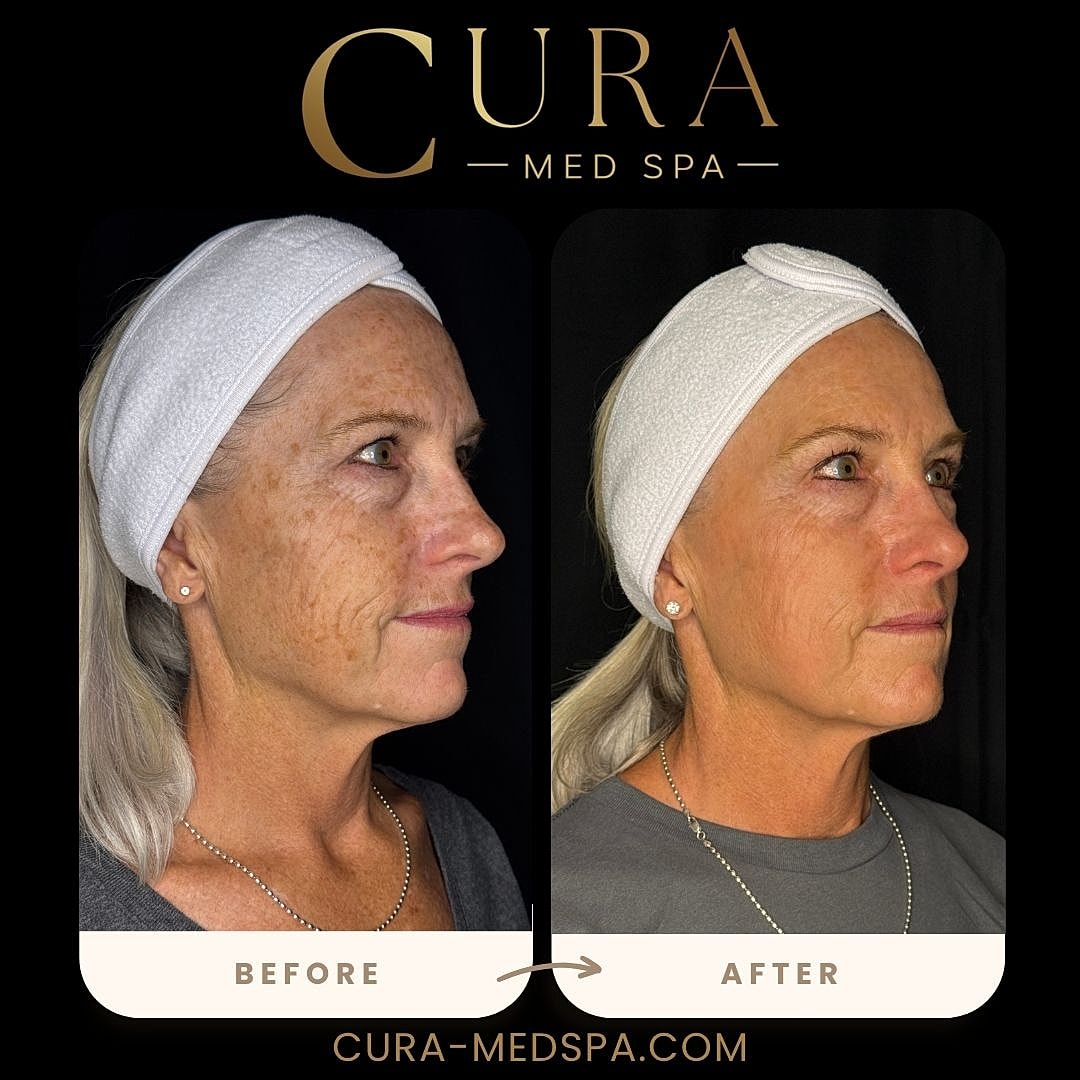 IPL Laser Gallery Before & After