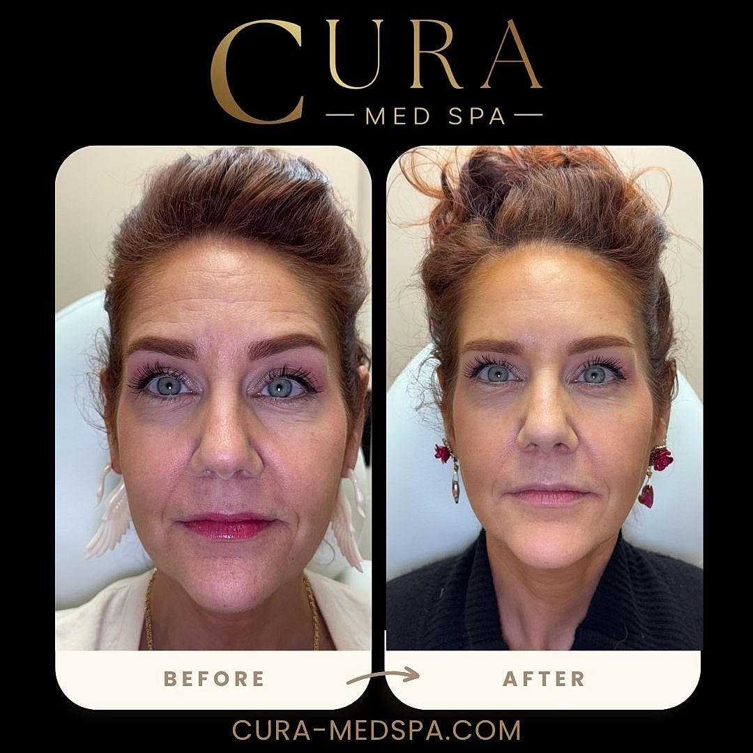 Botox Gallery Before & After