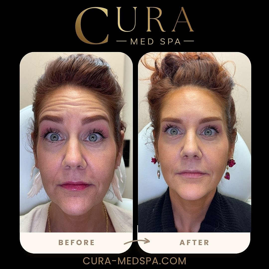 Botox Gallery Before & After