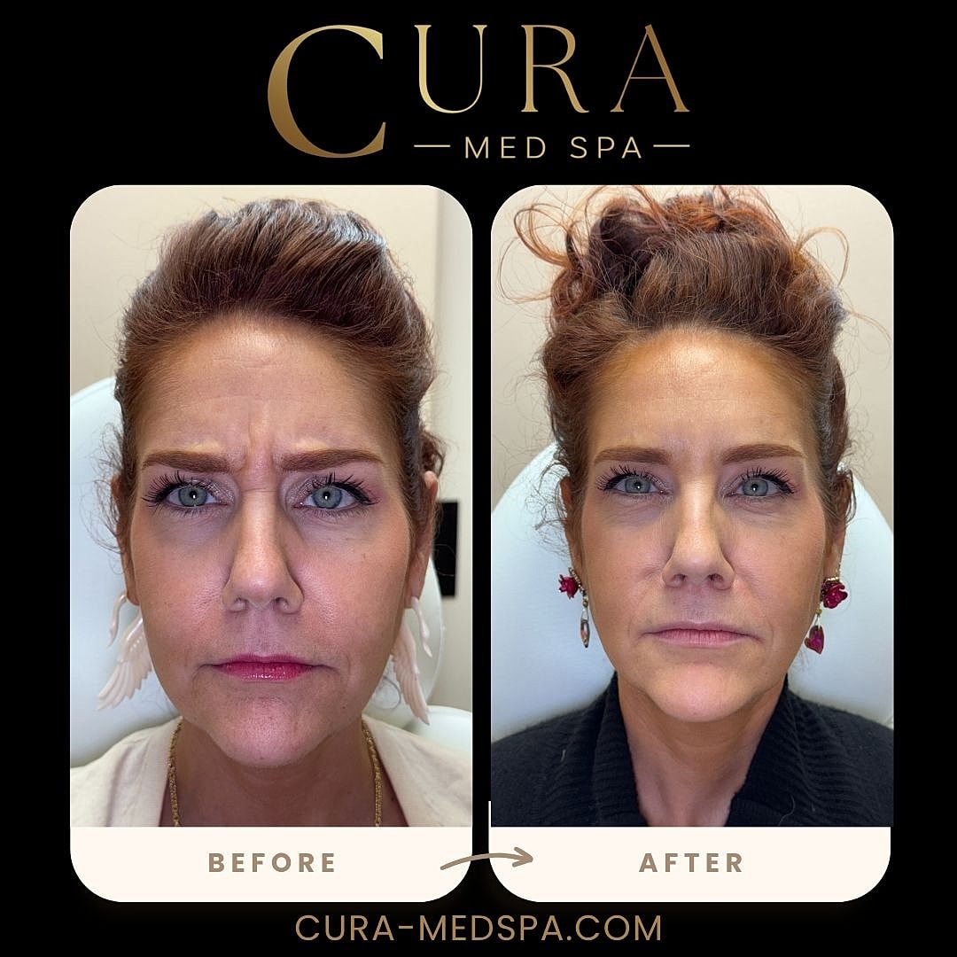 Botox Gallery Before & After
