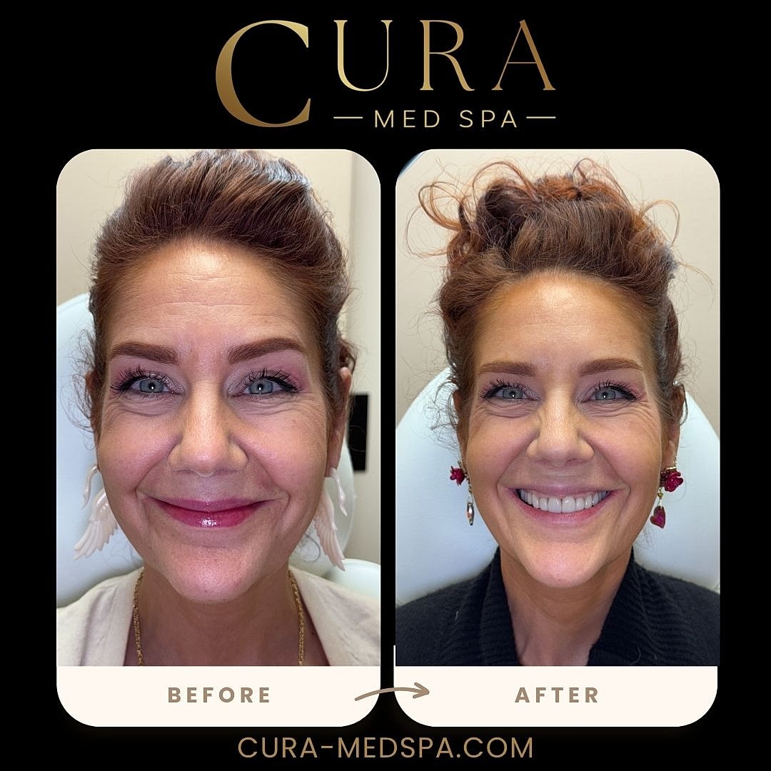 Botox Gallery Before & After