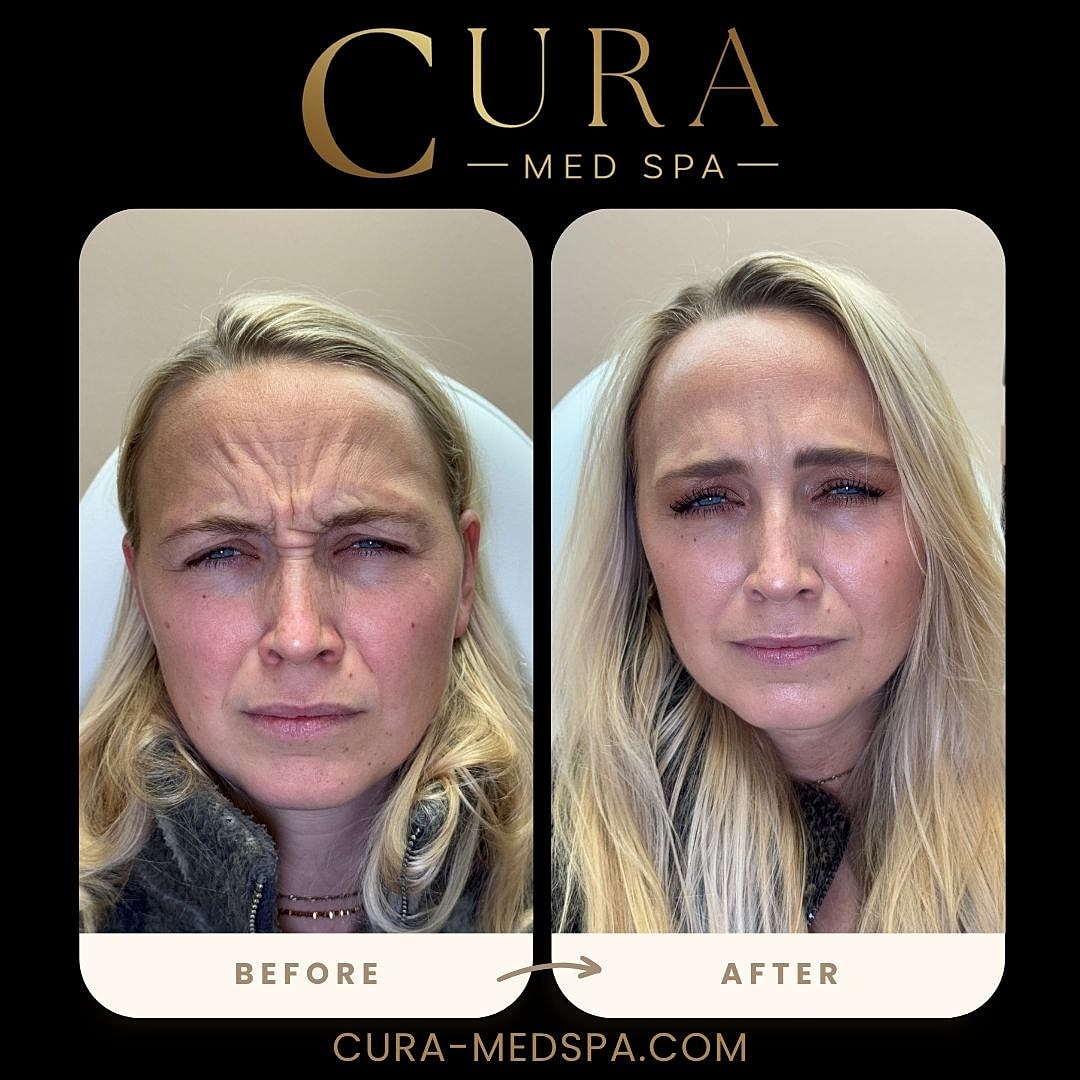 Botox Gallery Before & After