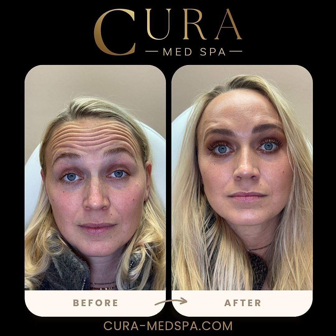 Botox Gallery Before & After