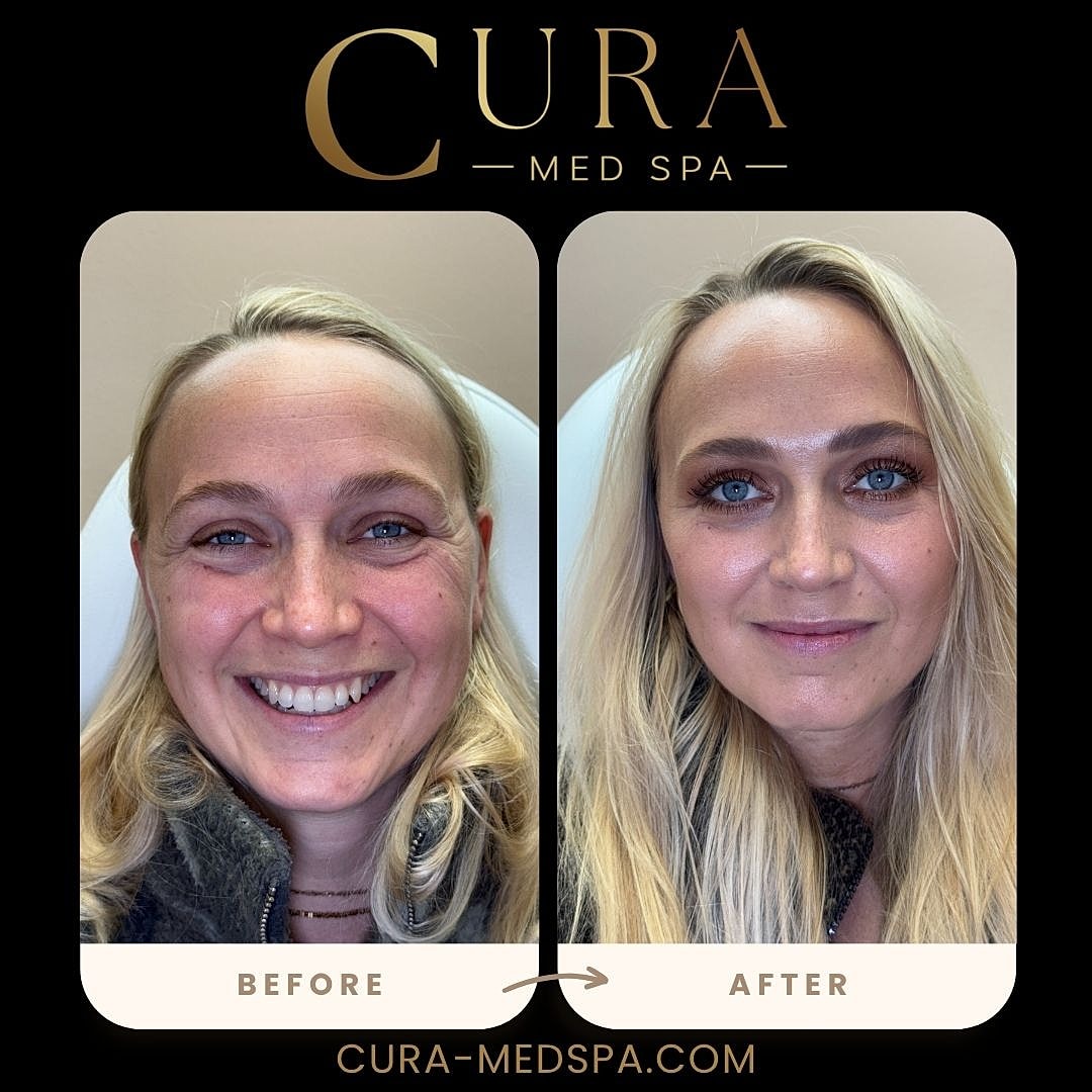 Botox Gallery Before & After
