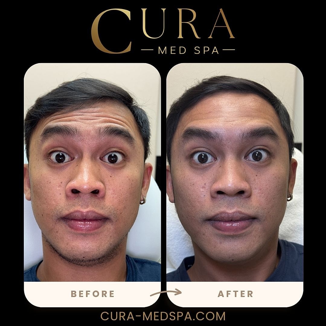 Botox Gallery Before & After