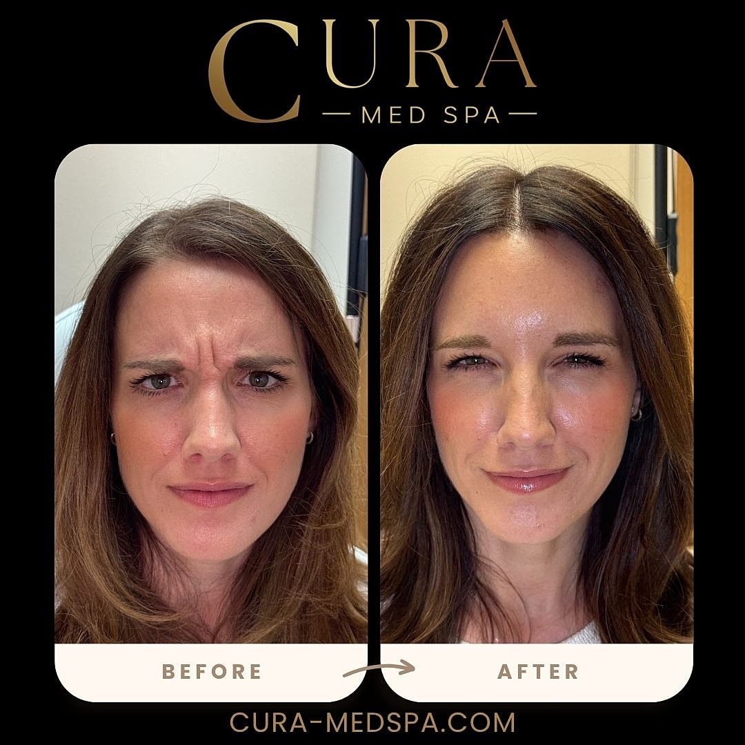 Botox Gallery Before & After