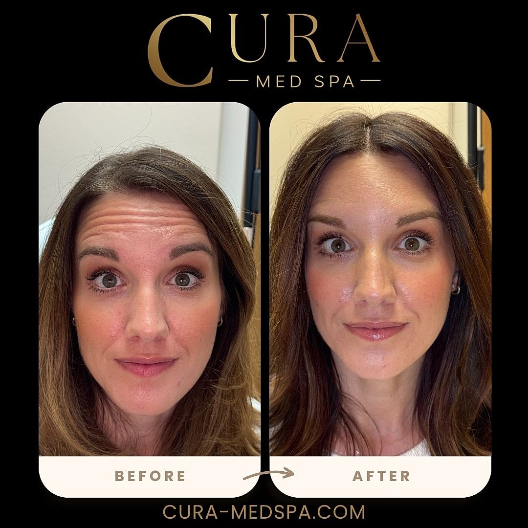 Botox Gallery Before & After