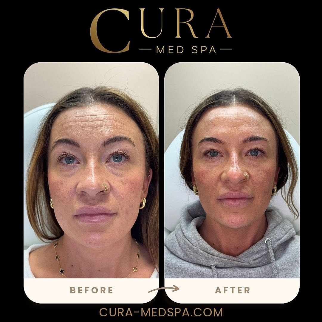 Botox Gallery Before & After