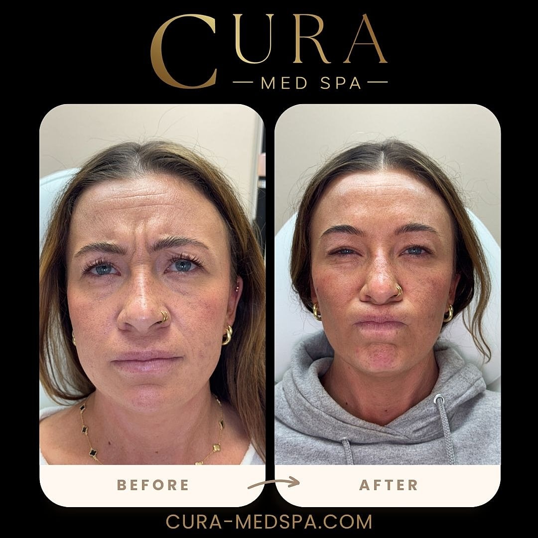 Botox Gallery Before & After