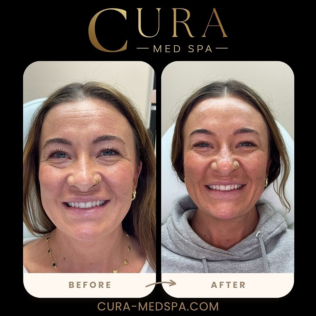 Botox Gallery Before & After