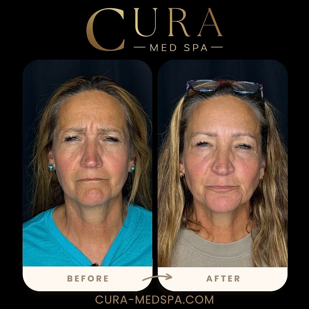 Botox Gallery Before & After