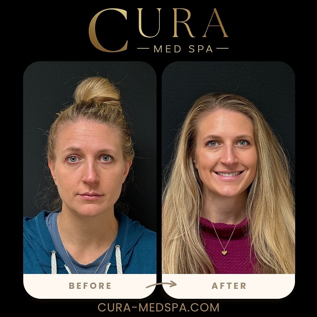 Botox Gallery Before & After