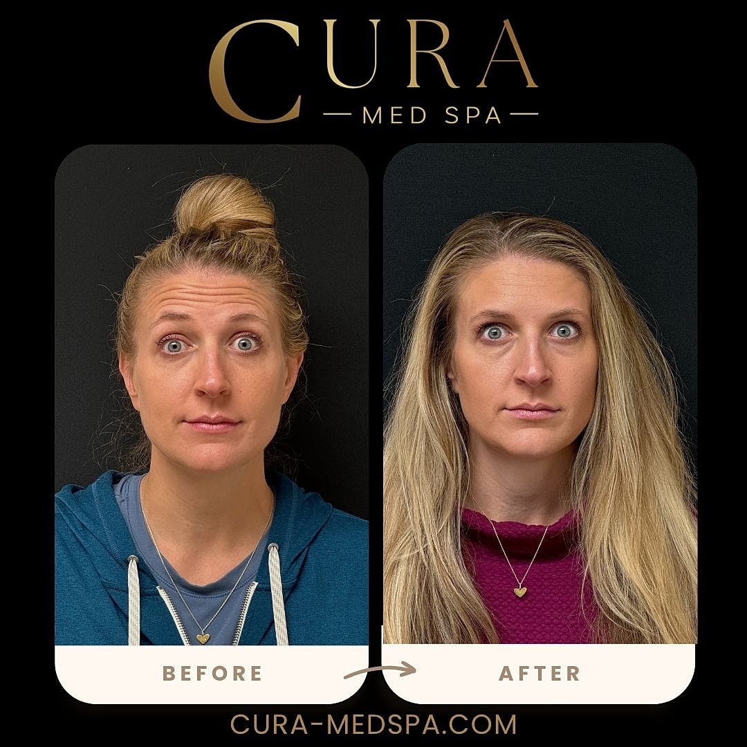 Botox Gallery Before & After