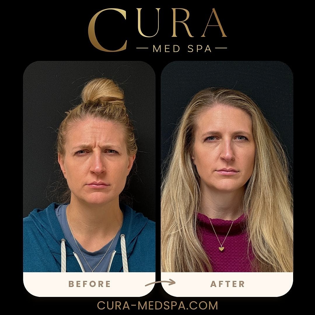 Botox Gallery Before & After