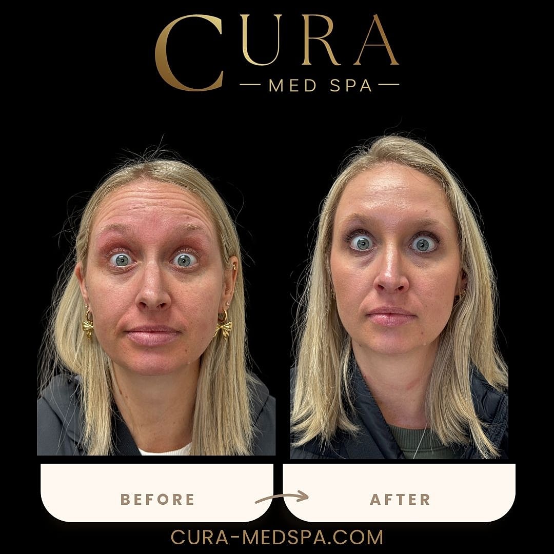Botox Gallery Before & After