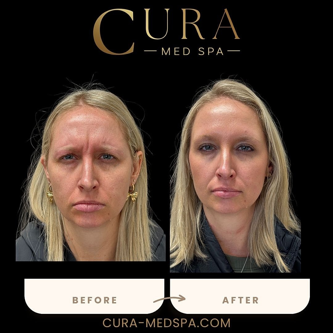 Botox Gallery Before & After