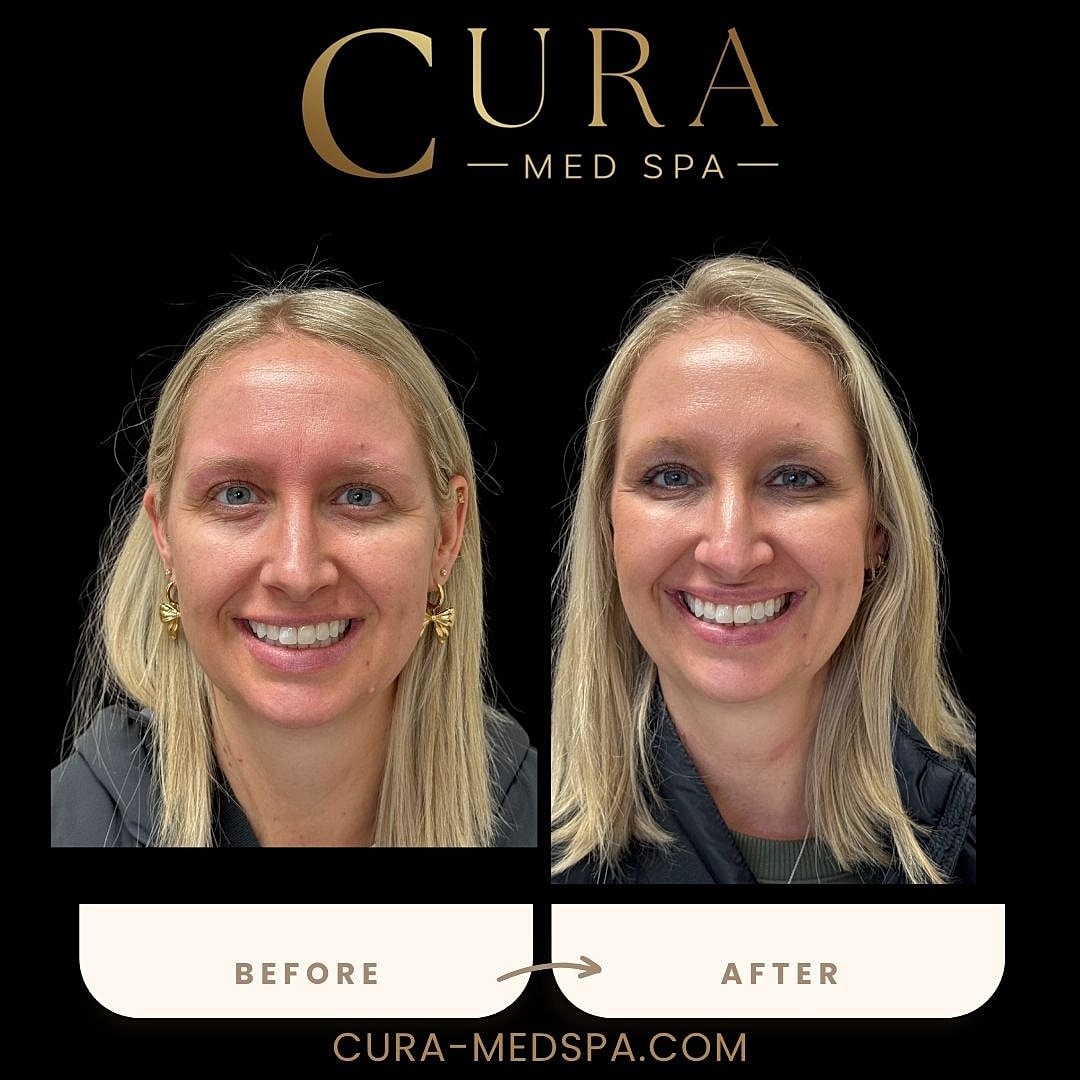 Botox Gallery Before & After
