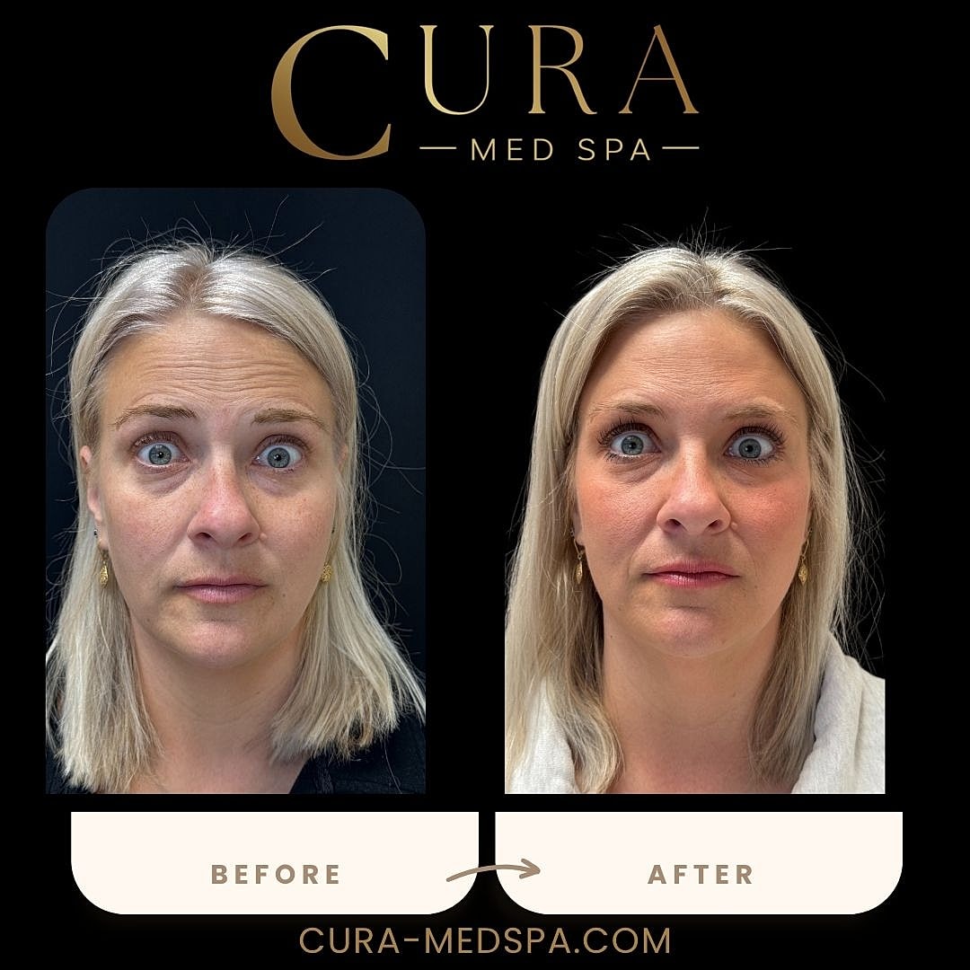Botox Gallery Before & After