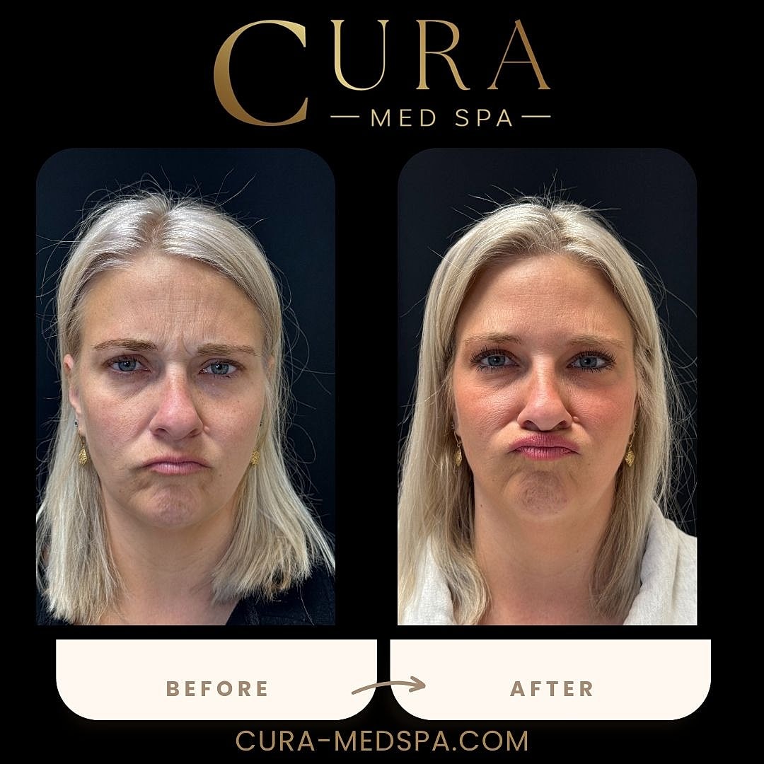 Botox Gallery Before & After