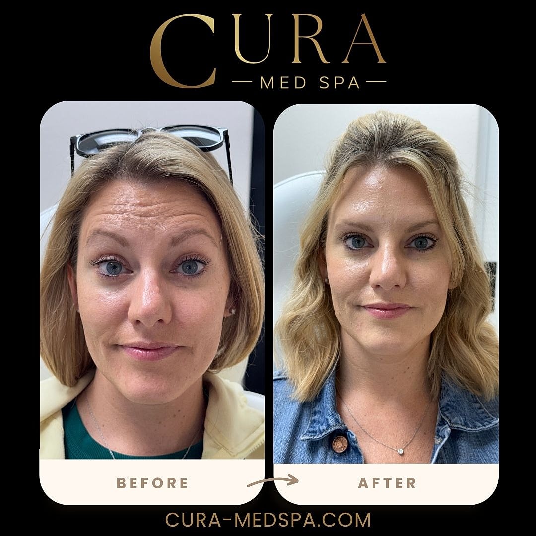 Botox Gallery Before & After