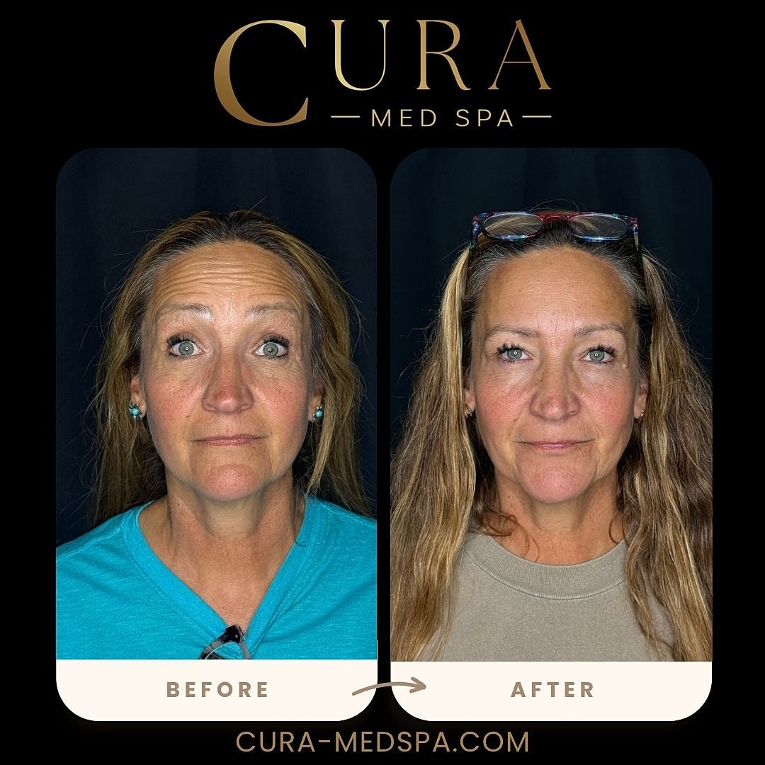Botox Gallery Before & After