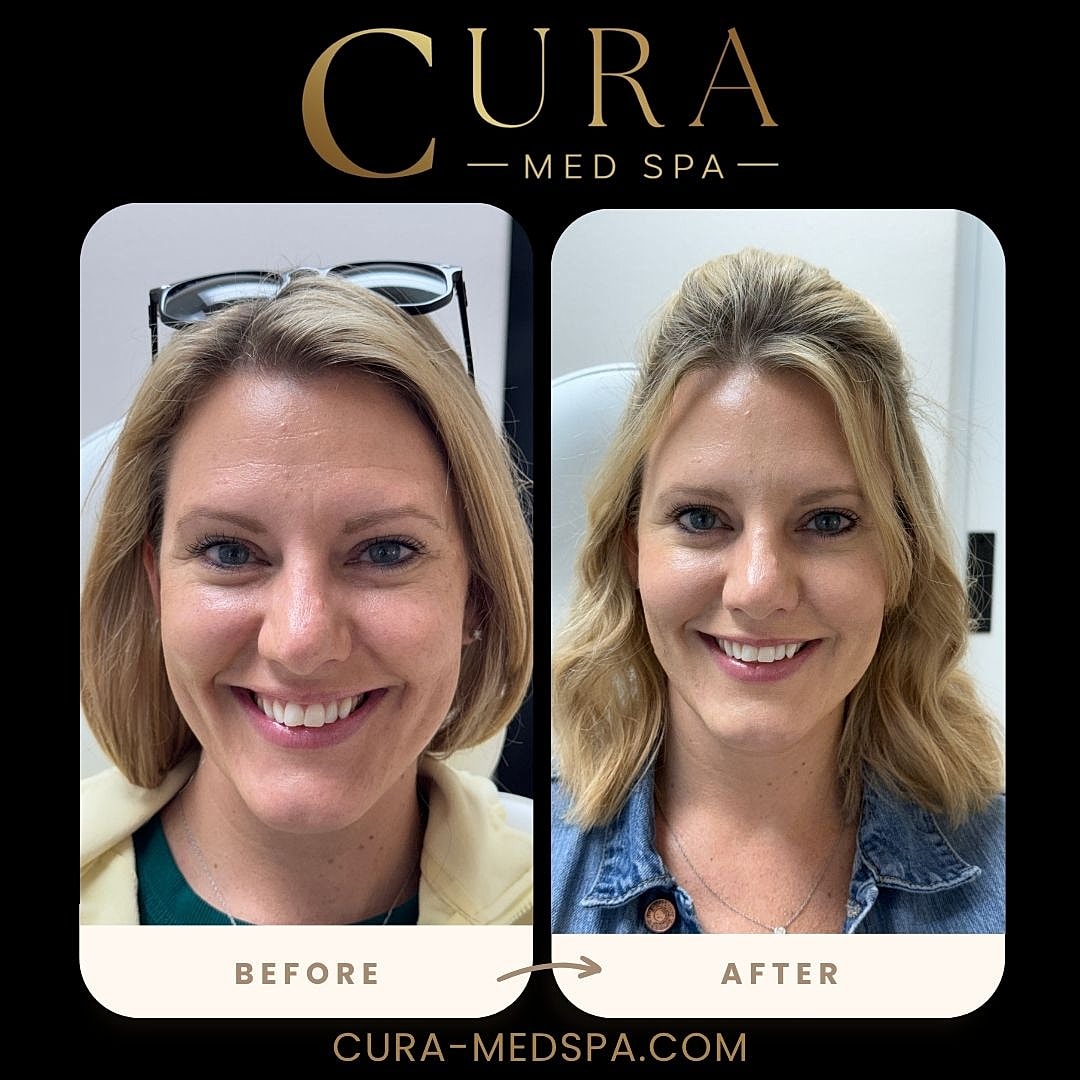 Botox Gallery Before & After