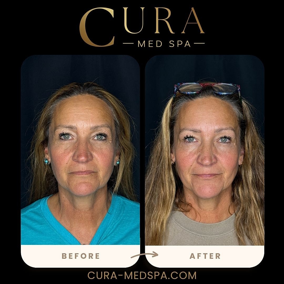 Botox Gallery Before & After