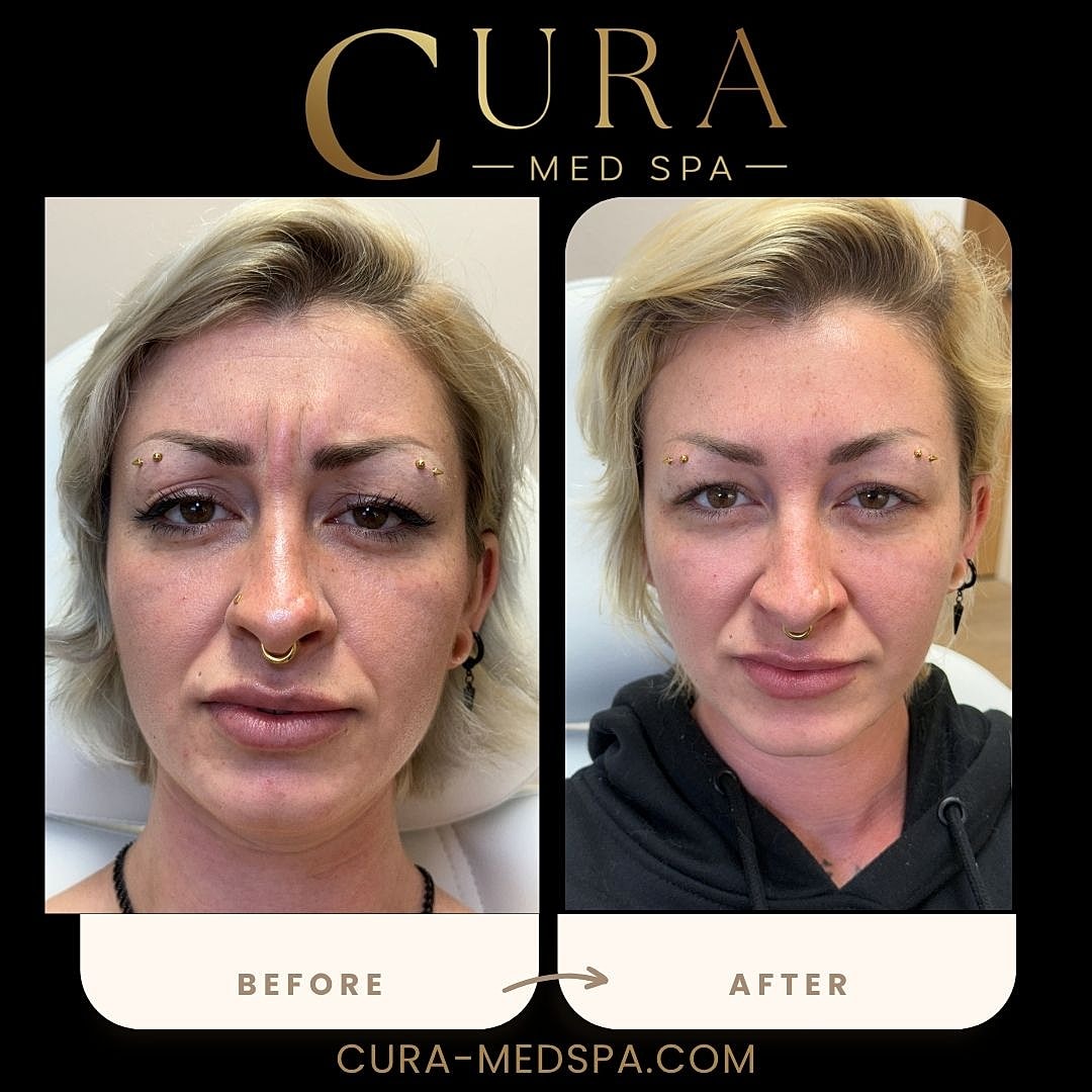 Botox Gallery Before & After