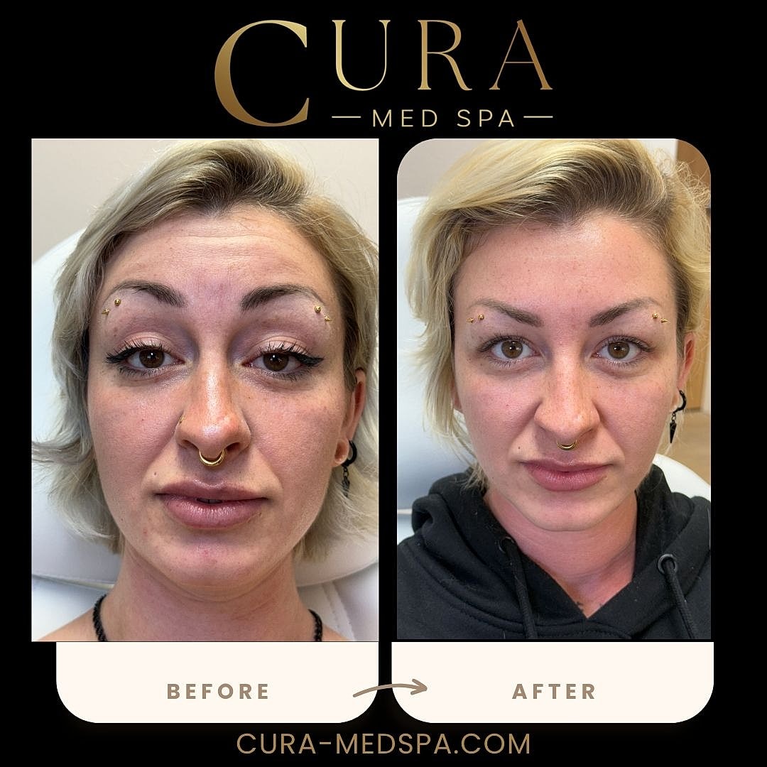 Botox Gallery Before & After