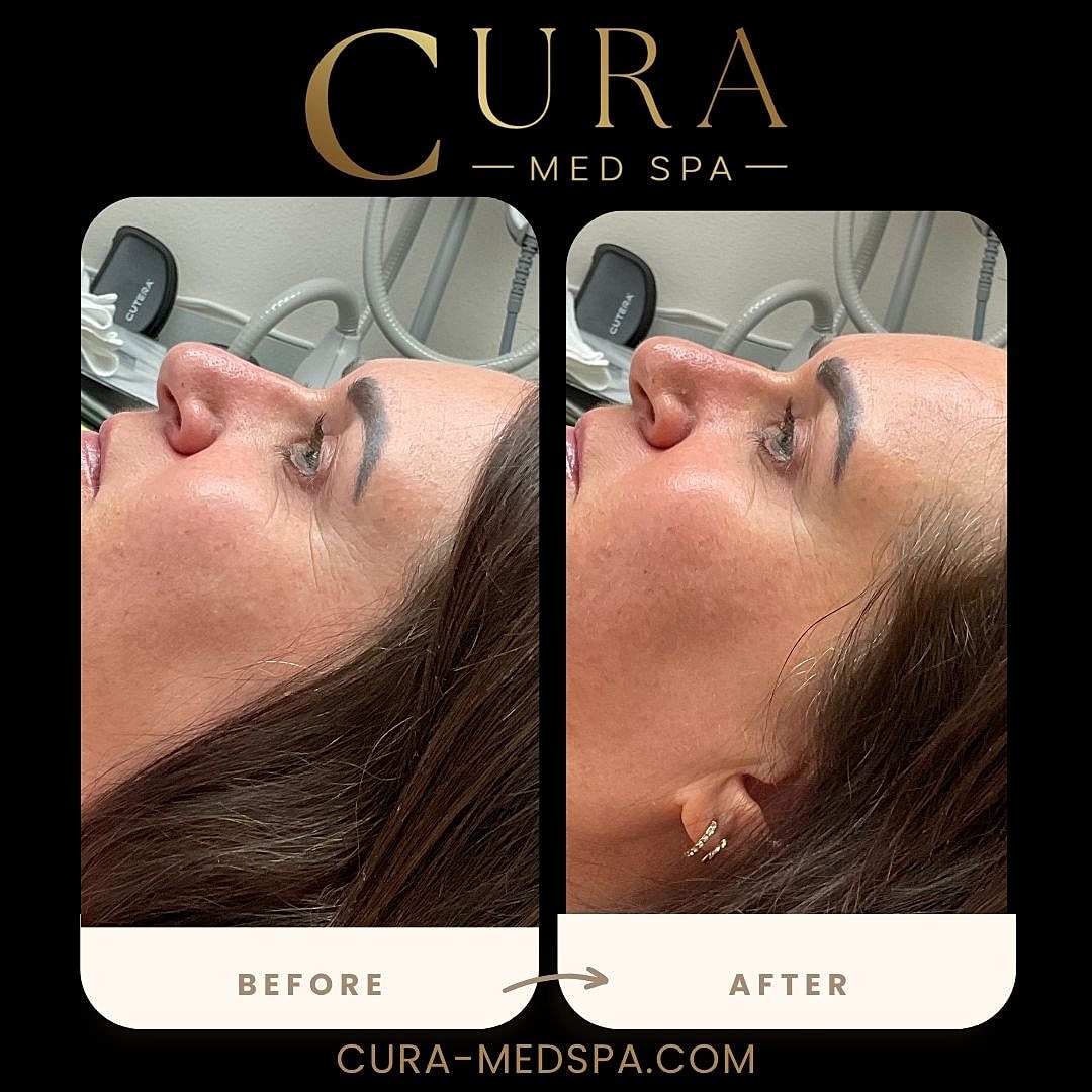 Chemical Peels Gallery Before & After