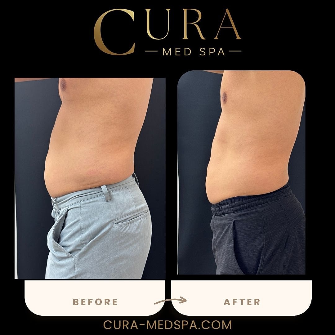 Body Sculpting (Weight Loss) Gallery Before & After