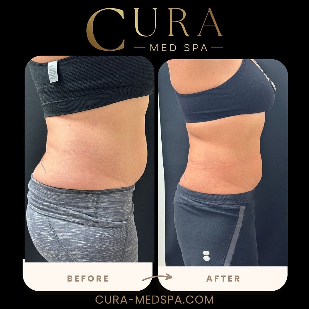 Body Sculpting (Weight Loss) Gallery Before & After
