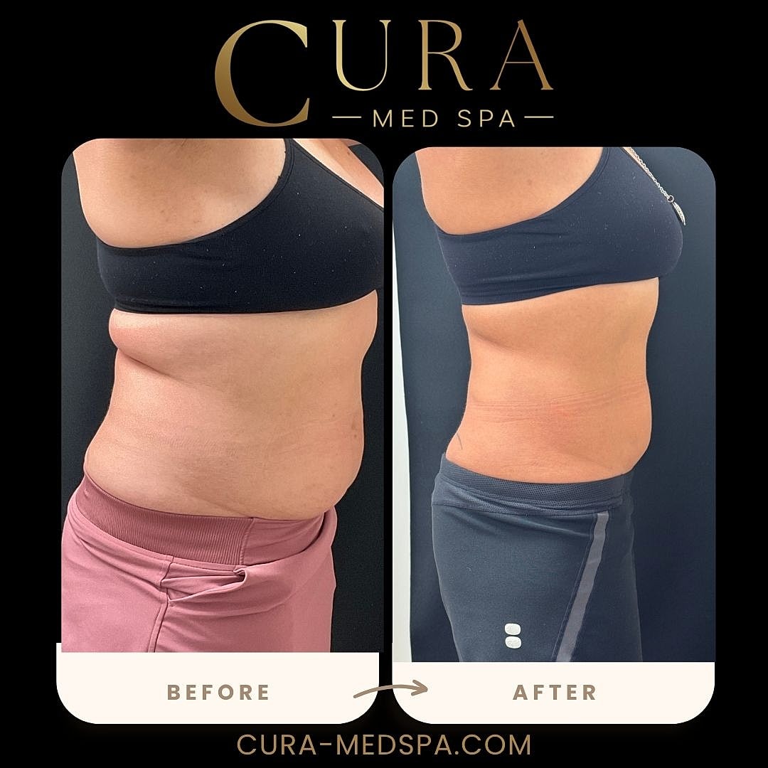 Body Sculpting (Weight Loss) Gallery Before & After