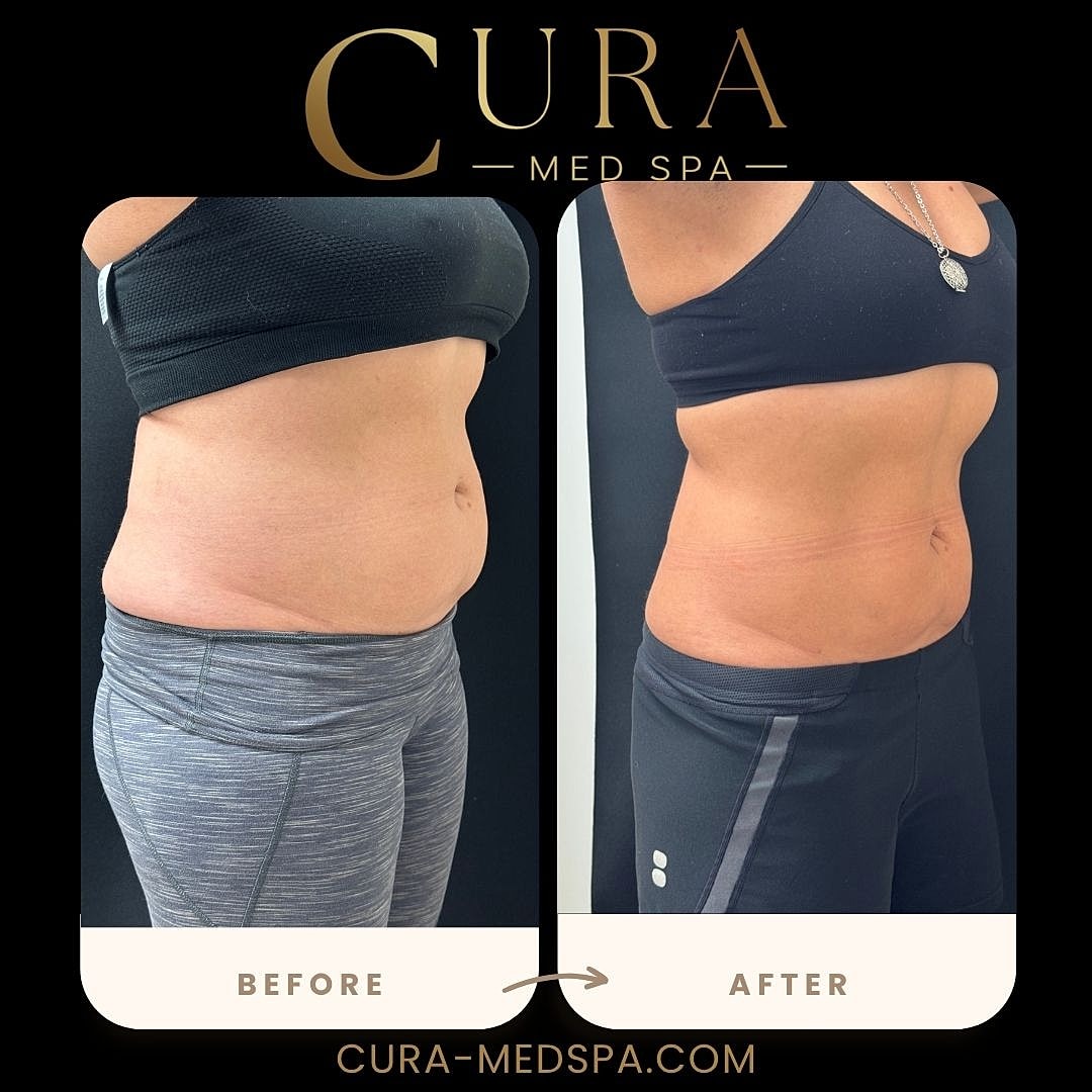Body Sculpting (Weight Loss) Gallery Before & After