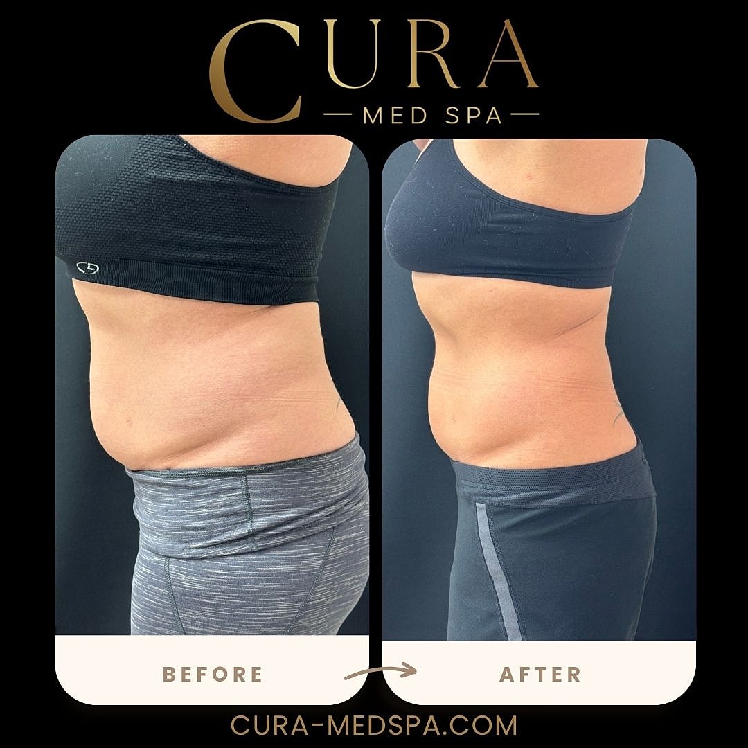 Body Sculpting (Weight Loss) Gallery Before & After