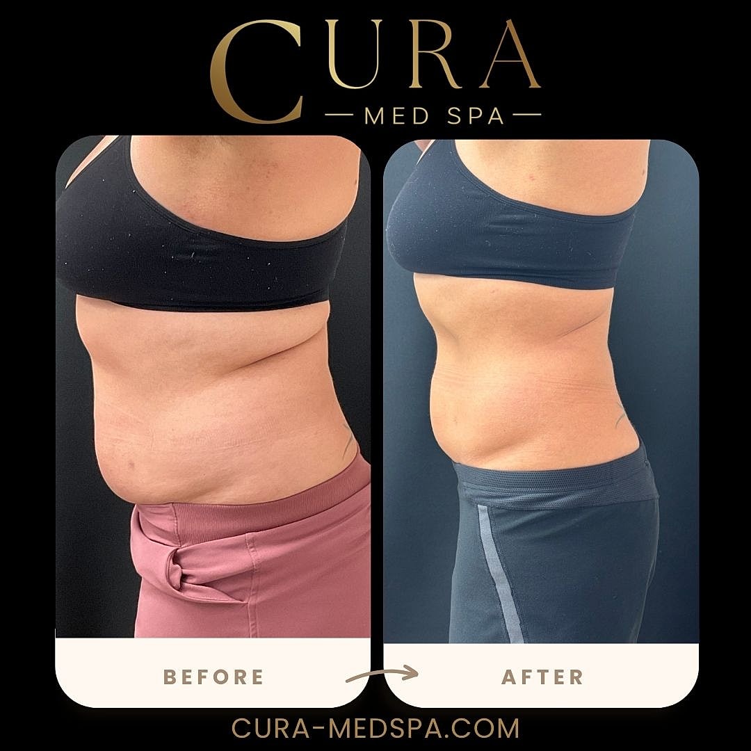Body Sculpting (Weight Loss) Gallery Before & After