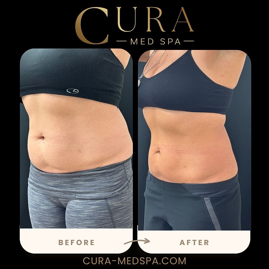 Body Sculpting (Weight Loss) Gallery Before & After