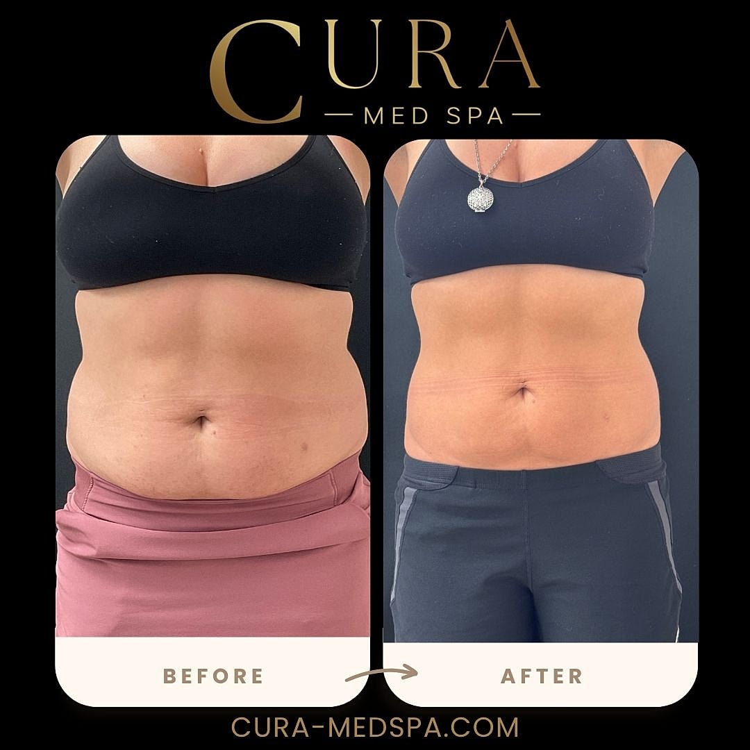 Body Sculpting (Weight Loss) Gallery Before & After