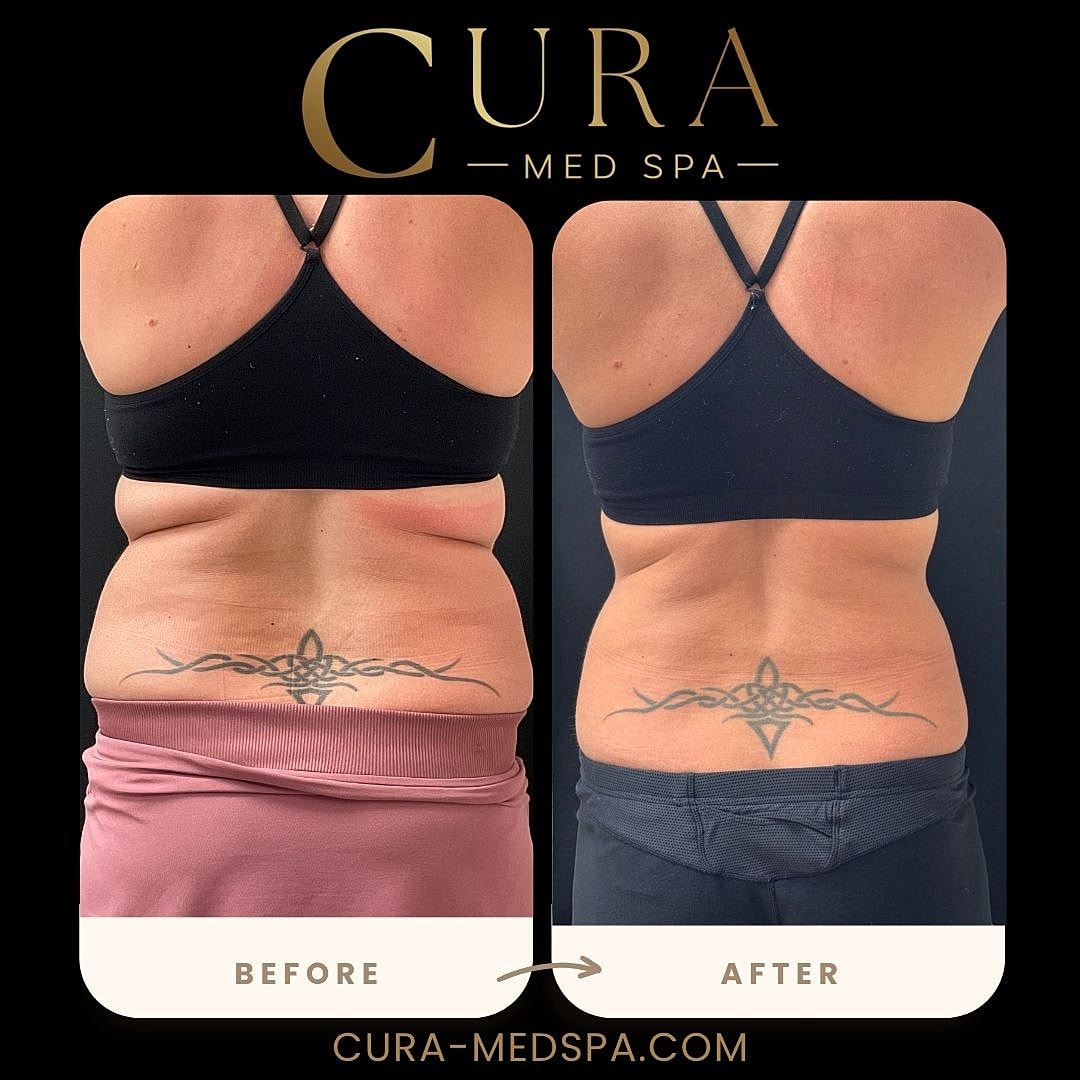 Body Sculpting (Weight Loss) Gallery Before & After