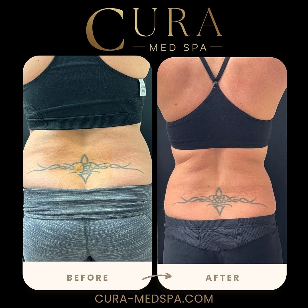 Body Sculpting (Weight Loss) Gallery Before & After